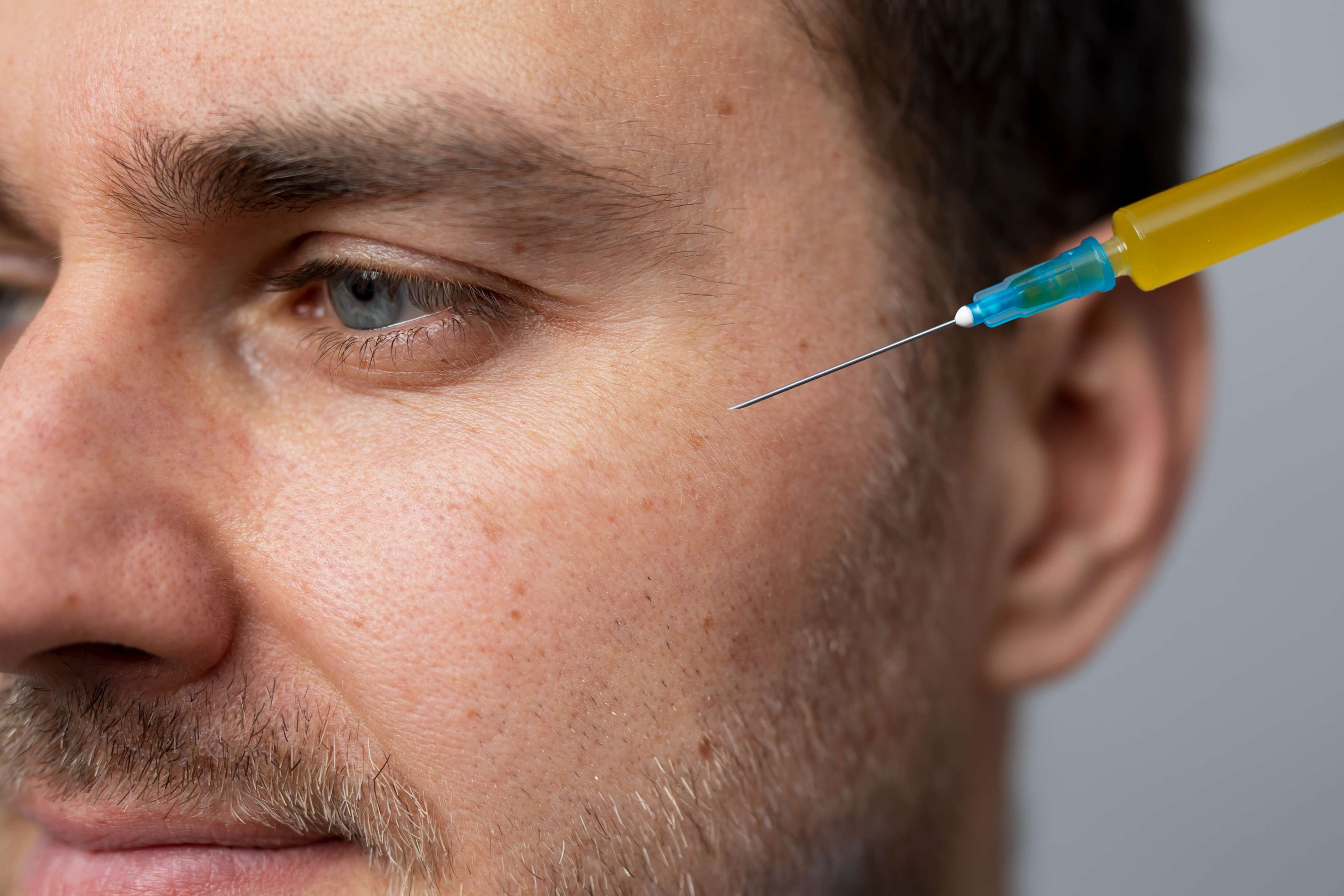 Polynucleotide skin rejuvenation results